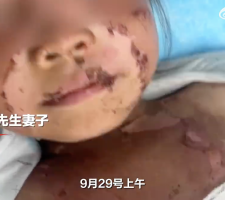 广东校园安全引发关注，女童遭高年级同学泼开水烫伤事件曝光
