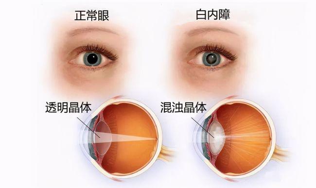 爱尔眼科义眼片价格指南，全面了解义眼片价格信息