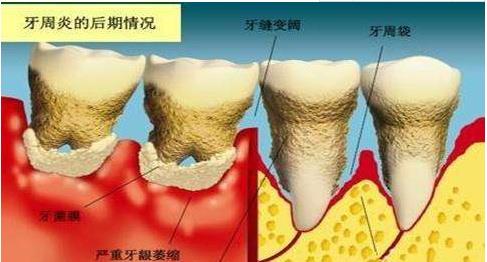 牙龈萎缩最新特效药，口腔健康的希望之光