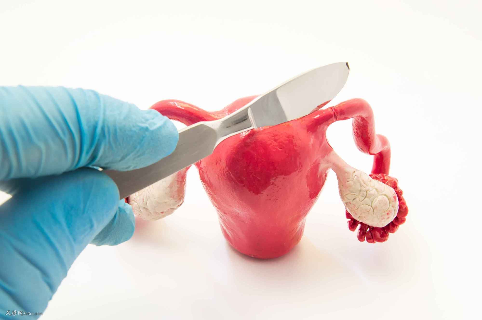 子宫腺肌症最新治疗方法详解与步骤指南