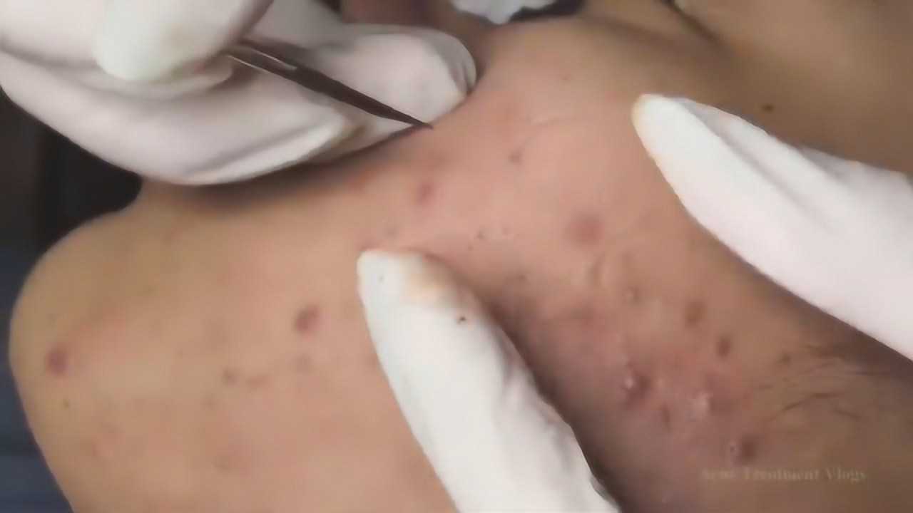 挤痘痘最新视频，心灵与自然的奇妙之旅