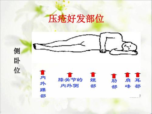 压疮分期与小明的康复之旅，爱的陪伴下的压疮奇遇