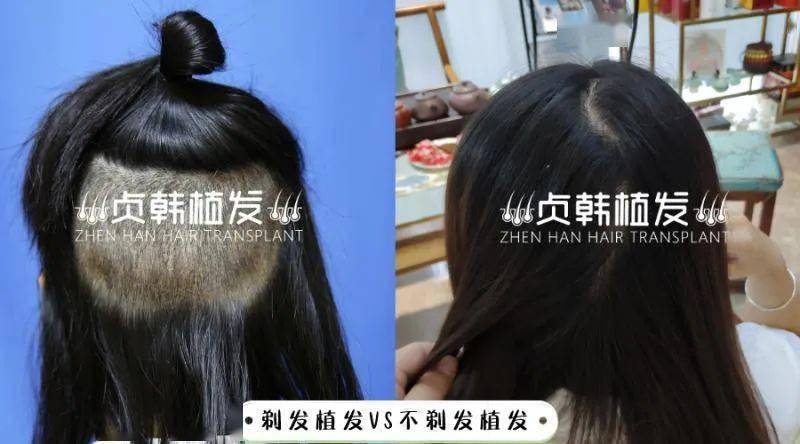 植发最新技术，重塑自信，神奇之旅启程